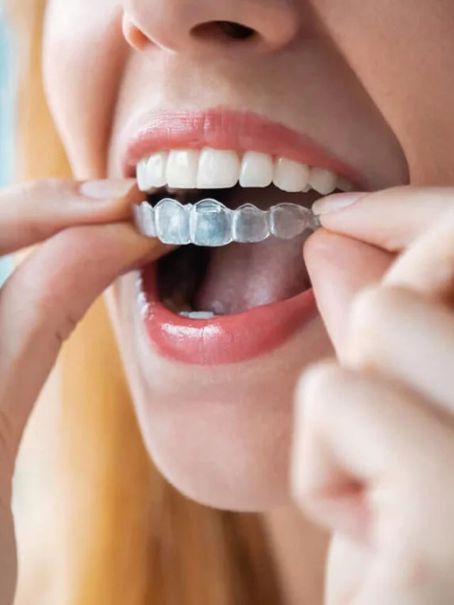 Straighten Your Teeth Discreetly With Invisalign® In Burlington, On