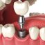 What to Expect When it is Time to Get a Dental Implant