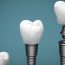 Benefits of Replacing Missing Teeth with Dental Implants