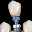 Dental Implants for the Look and Feel of Natural Teet