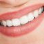 Want to Be Known for Your Dazzling Smile? Try Professional Teeth Whitening