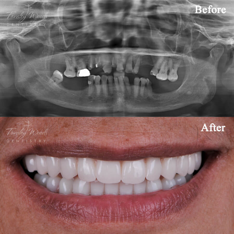 Dental Implants - Before and After Actual Patient Result Case-2 at Tansley Woods Dentistry