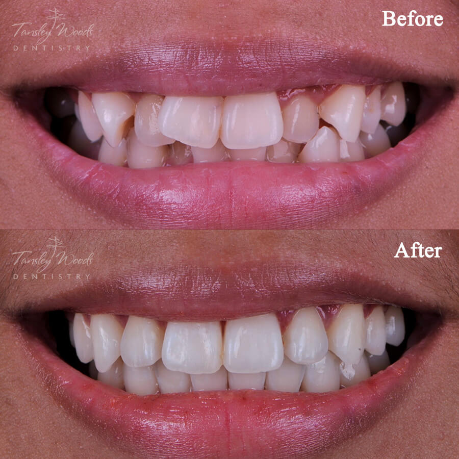 Invisalign - Before and After Actual Patient Result Case-1 at Tansley Woods Dentistry