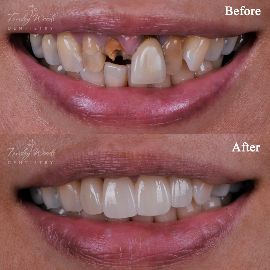 Soft Tissue Grafting - Before and After Actual Patient Result Case-1 at Tansley Woods Dentistry