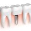 Caring for Your Dental Implants: Best Practices and Routine Maintenance