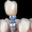 How Do Dental Implants Restore Your Smile?